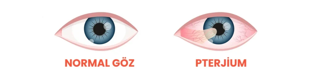Pterjiyum (Göz Eti) Ameliyatı ve Tedavisi