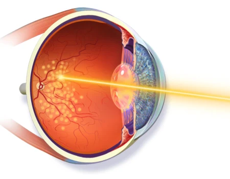 diger-lazer-yontemleri-retina-hastaliklari-argon-lazer