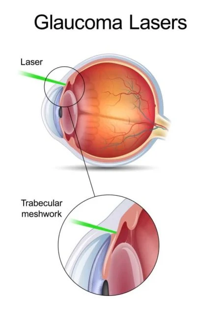 diger-lazer-yontemleri-glaucoma-lasers